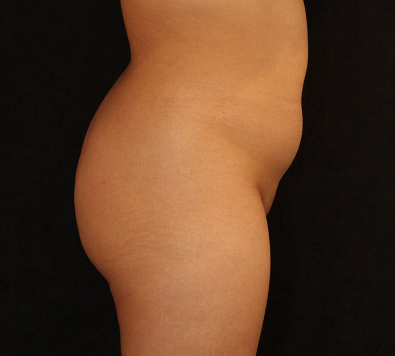Liposuction Before & After Gallery - Patient 183427 - Image 5