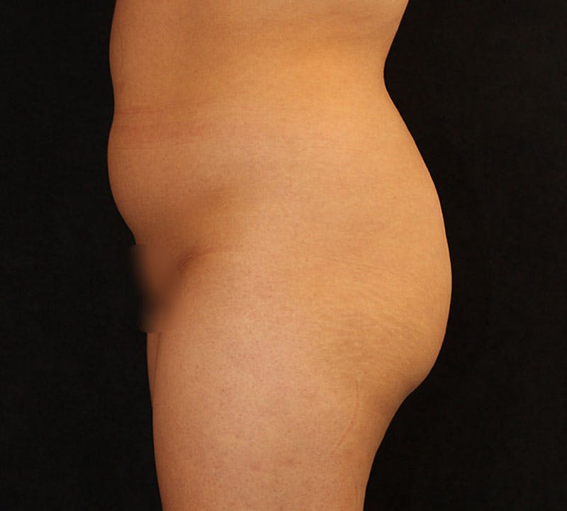 Liposuction Before & After Gallery - Patient 183427 - Image 7