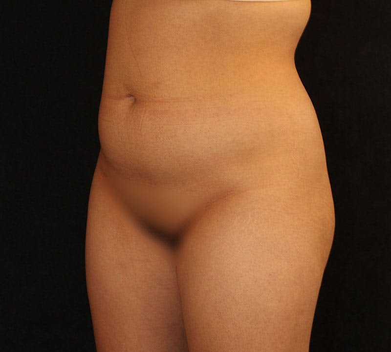 Liposuction Before & After Gallery - Patient 183427 - Image 9