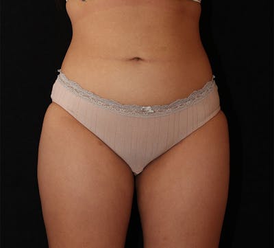 Liposuction Before & After Gallery - Patient 183427 - Image 2