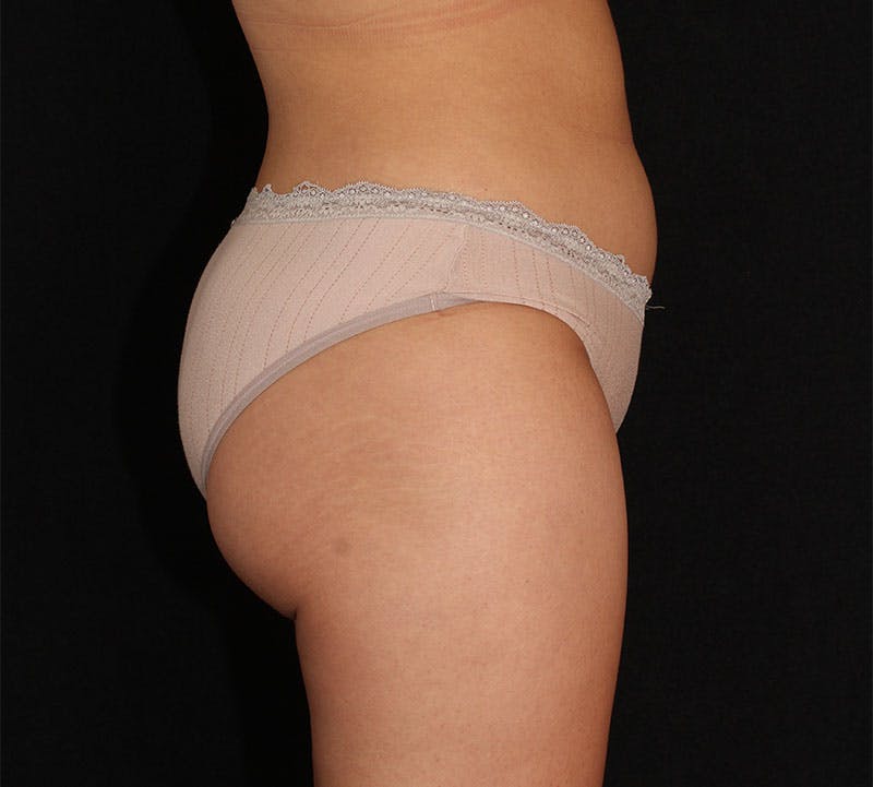 Liposuction Before & After Gallery - Patient 183427 - Image 6