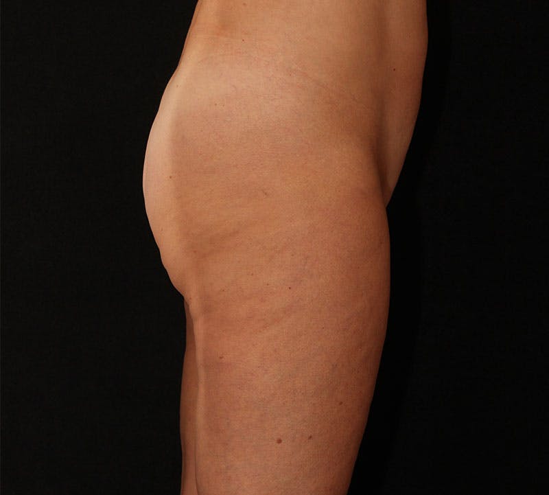 Liposuction Before & After Gallery - Patient 938205 - Image 7