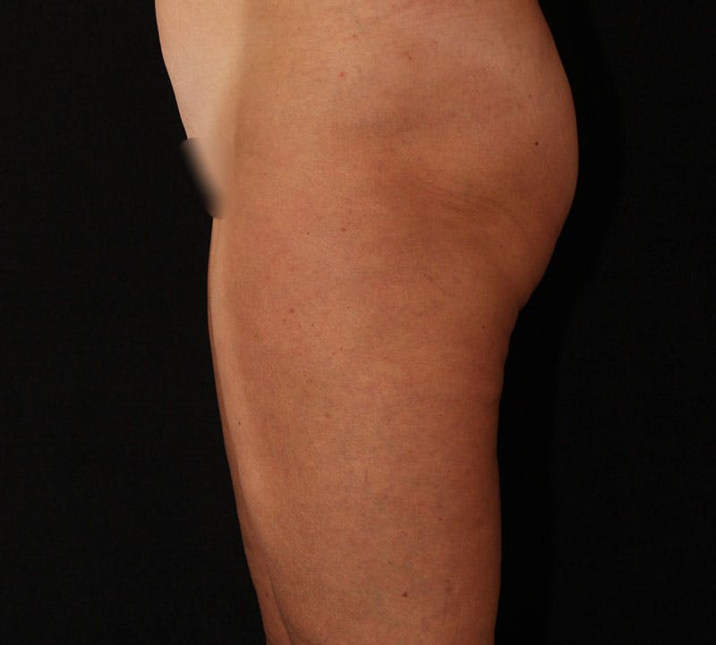 Liposuction Before & After Gallery - Patient 938205 - Image 5