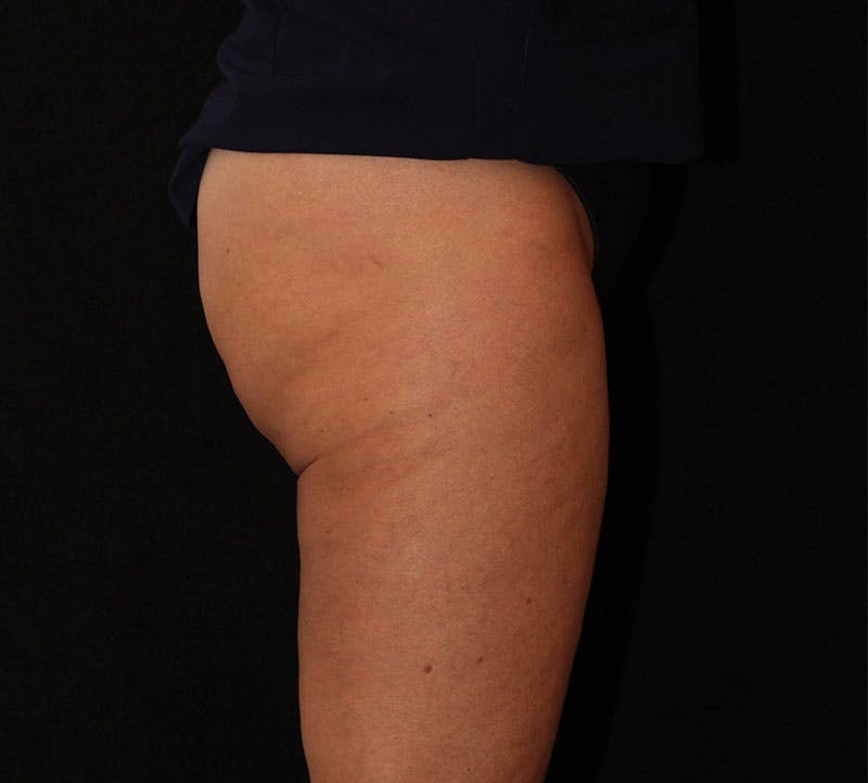 Liposuction Before & After Gallery - Patient 938205 - Image 8