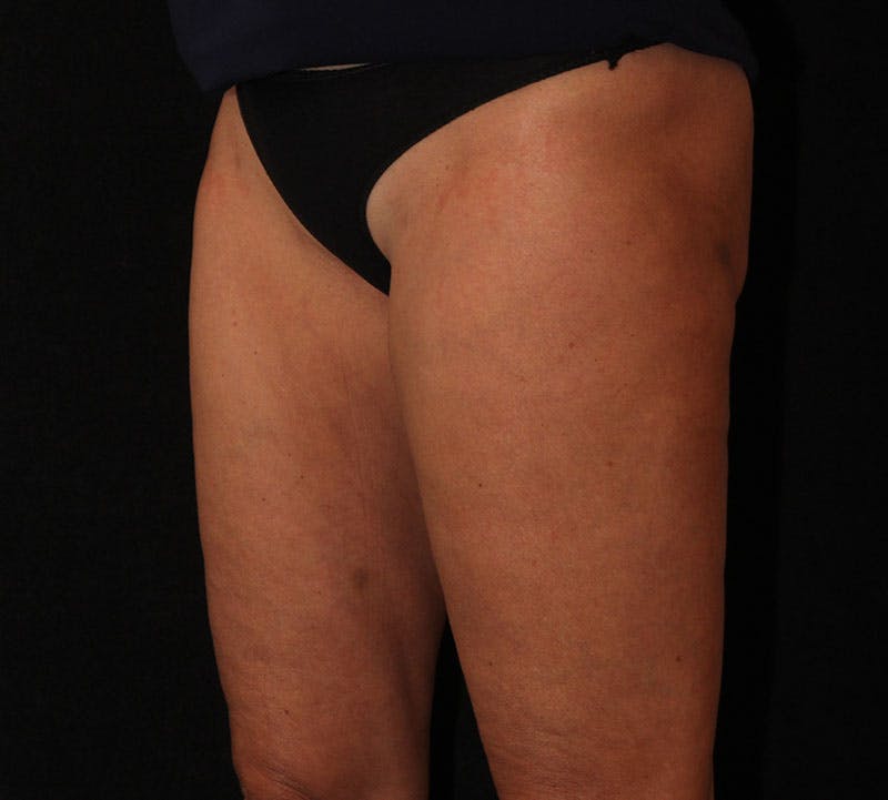 Liposuction Before & After Gallery - Patient 938205 - Image 4