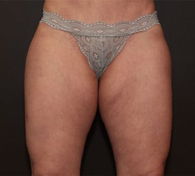 Liposuction Before & After Gallery - Patient 223197 - Image 1