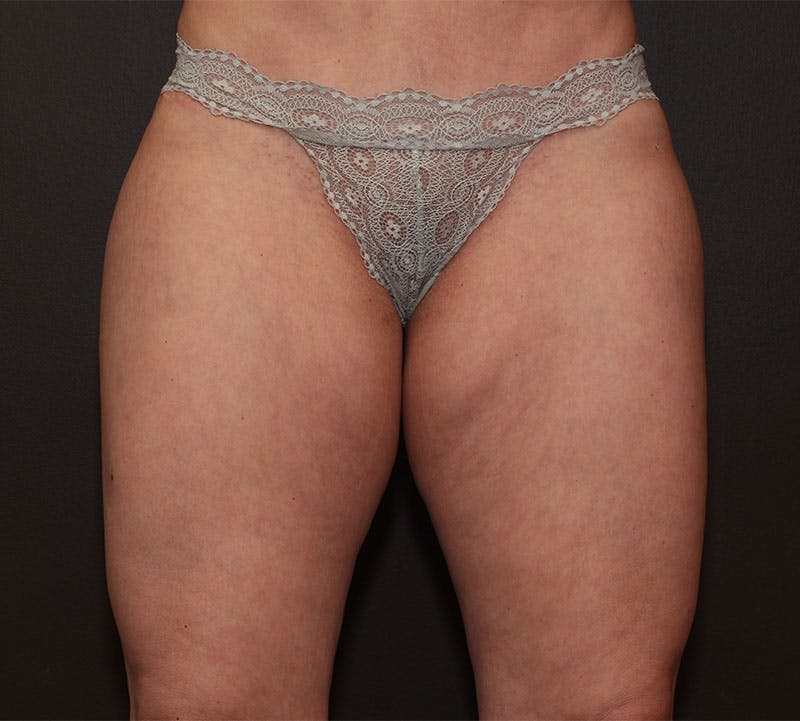 Liposuction Before & After Gallery - Patient 223197 - Image 1