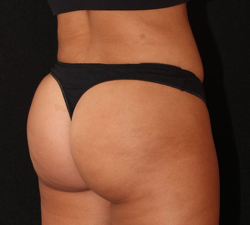 Brazilian Butt Lift Before & After Gallery - Patient 836012 - Image 4