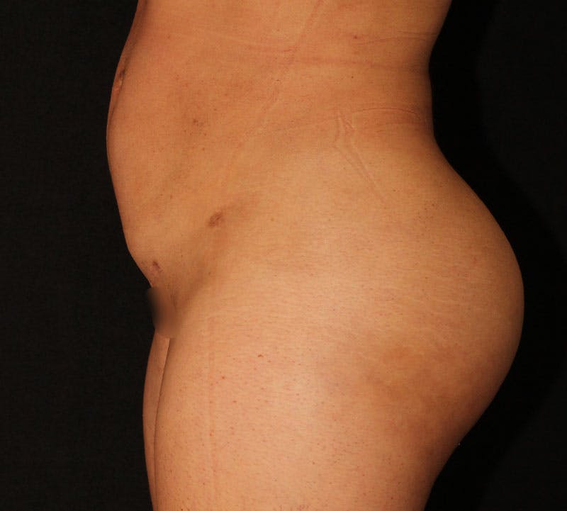 Brazilian Butt Lift Before & After Gallery - Patient 373667 - Image 14