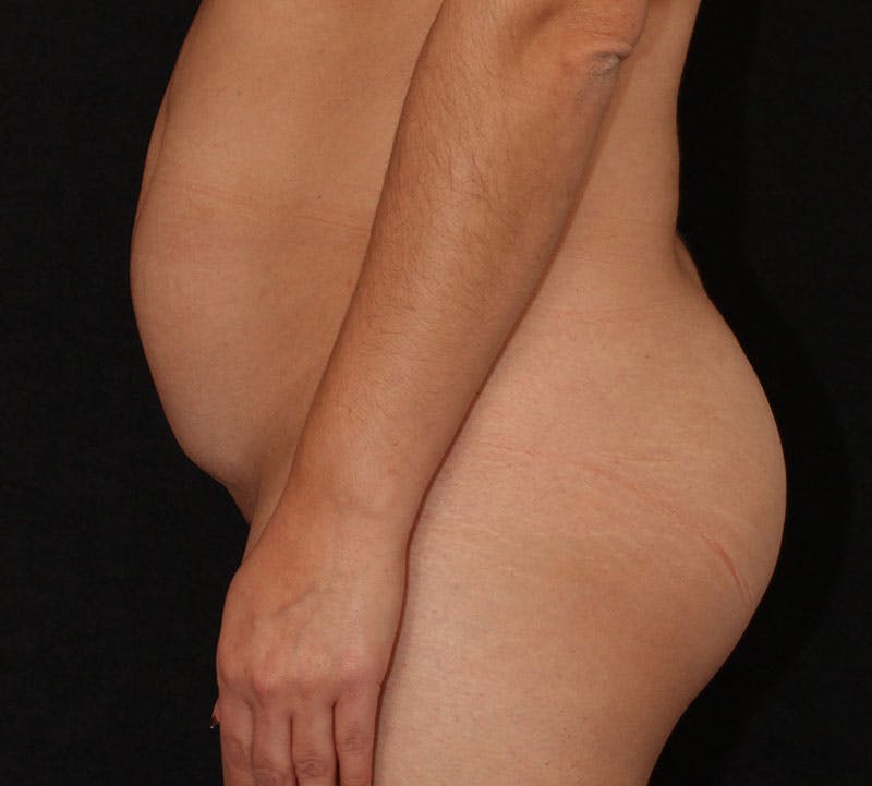 Brazilian Butt Lift Before & After Gallery - Patient 373667 - Image 13