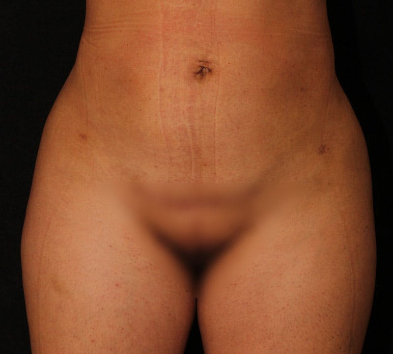 Brazilian Butt Lift Before & After Gallery - Patient 373667 - Image 10