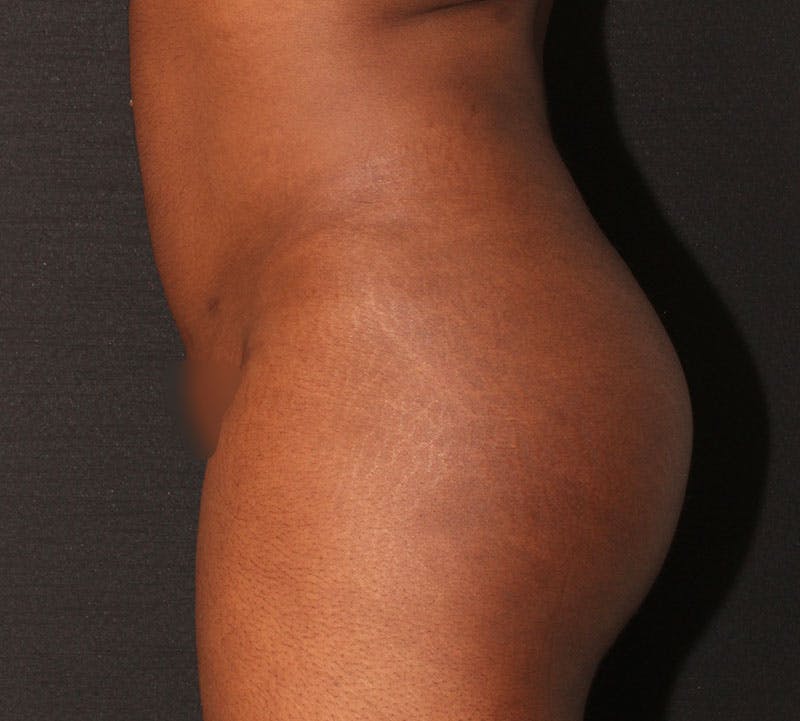 Brazilian Butt Lift Before & After Gallery - Patient 183125 - Image 14