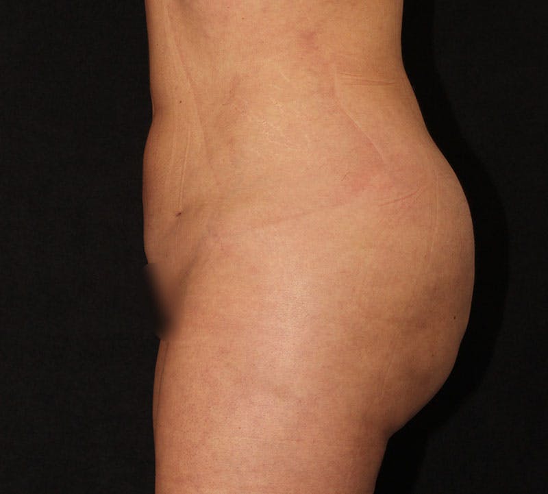 Brazilian Butt Lift Before & After Gallery - Patient 891042 - Image 14