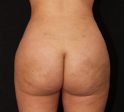 Brazilian Butt Lift Before & After Gallery - Patient 891042 - Image 2