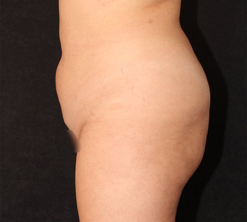 Brazilian Butt Lift Before & After Gallery - Patient 891042 - Image 13