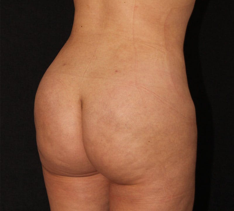 Brazilian Butt Lift Before & After Gallery - Patient 891042 - Image 4