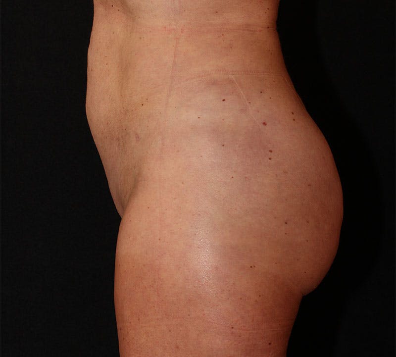 Brazilian Butt Lift Before & After Gallery - Patient 359588 - Image 10