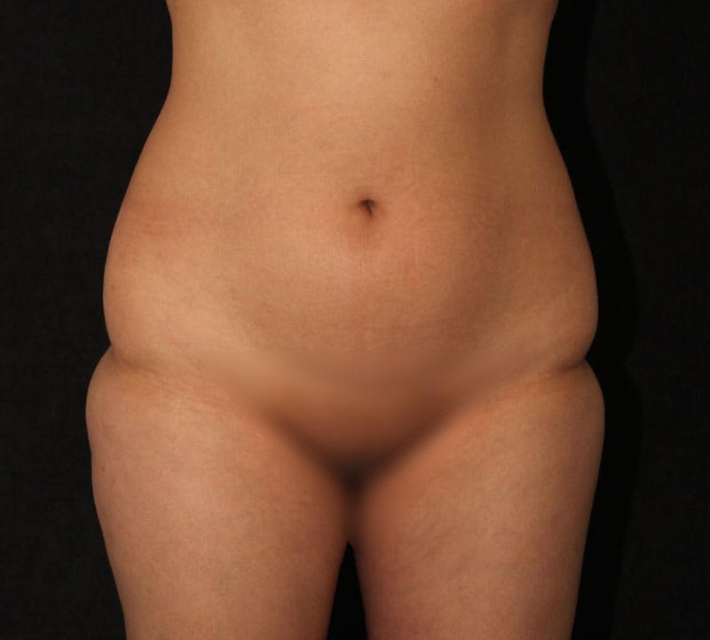 Brazilian Butt Lift Before & After Gallery - Patient 422479 - Image 7