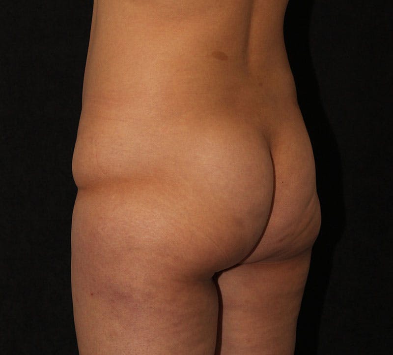 Brazilian Butt Lift Before & After Gallery - Patient 422479 - Image 11