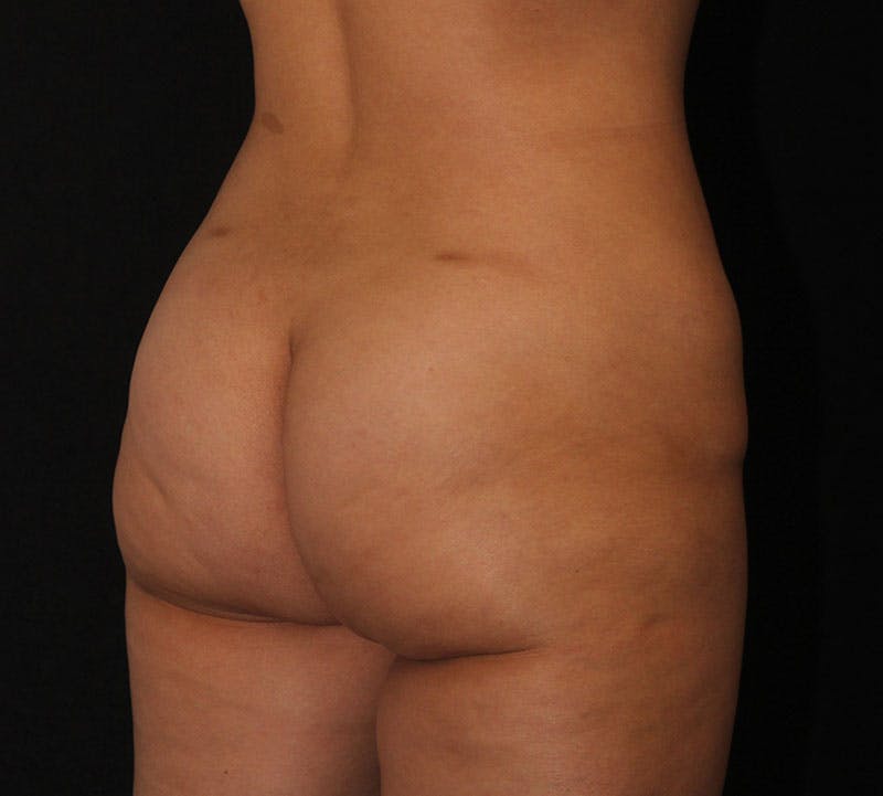 Brazilian Butt Lift Before & After Gallery - Patient 422479 - Image 4