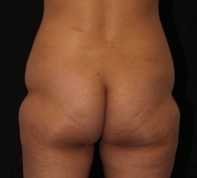 Brazilian Butt Lift Before & After Gallery - Patient 422479 - Image 1