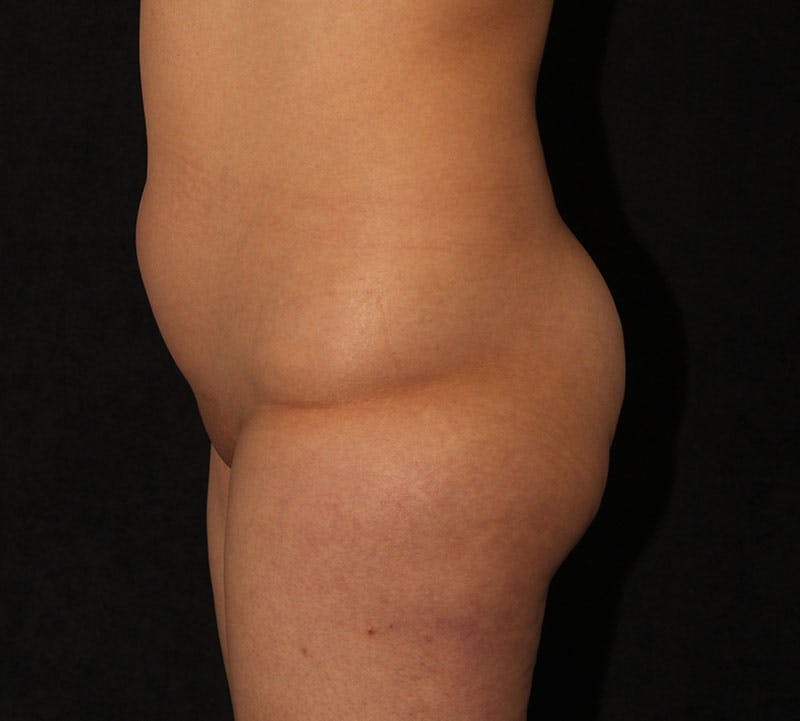 Brazilian Butt Lift Before & After Gallery - Patient 422479 - Image 9