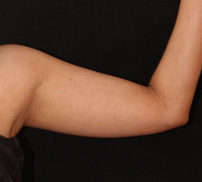 Bodytite Before & After Gallery - Patient 344724 - Image 1
