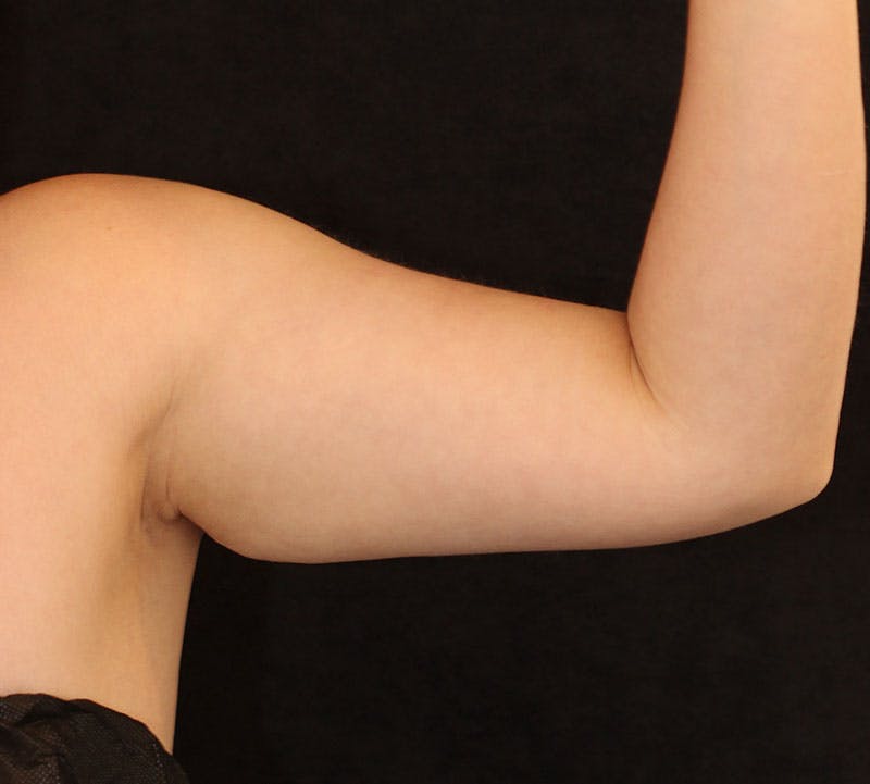 Bodytite Before & After Gallery - Patient 411049 - Image 5