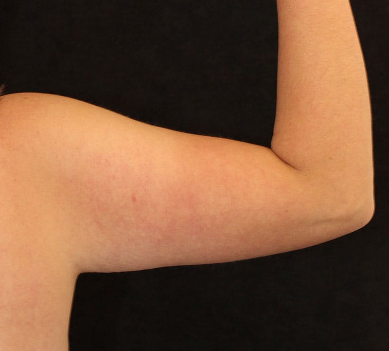 Bodytite Before & After Gallery - Patient 411049 - Image 3