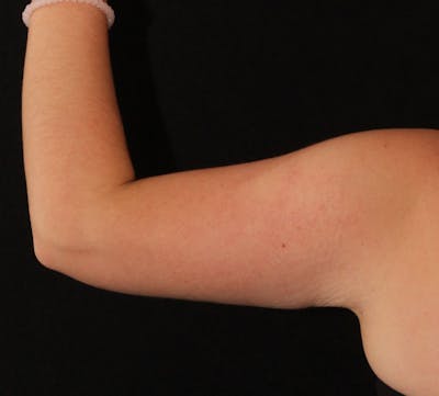 Bodytite Before & After Gallery - Patient 411049 - Image 2