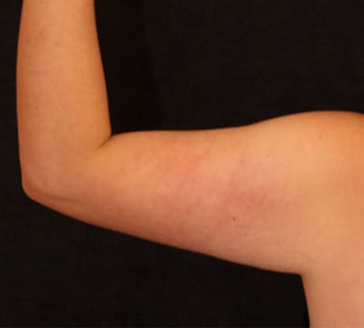 Bodytite Before & After Gallery - Patient 411049 - Image 1