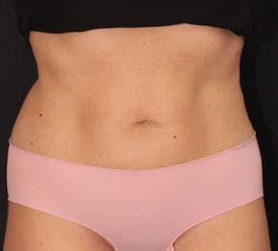 Bodytite Before & After Gallery - Patient 350103 - Image 2
