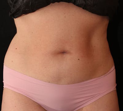 Bodytite Before & After Gallery - Patient 350103 - Image 1