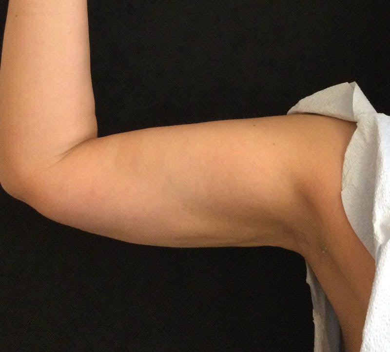 Bodytite Before & After Gallery - Patient 218572 - Image 8