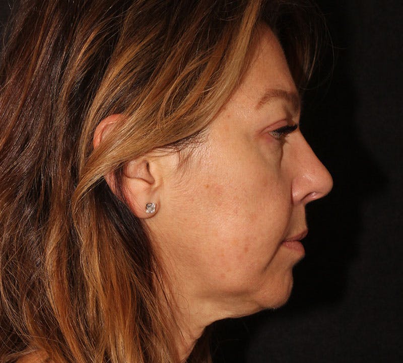 Browlift/Upper Blepharoplasty Before & After Gallery - Patient 393545 - Image 6