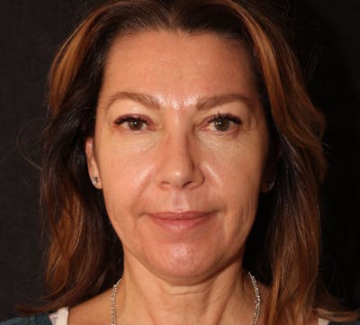 Browlift/Upper Blepharoplasty Before & After Gallery - Patient 393545 - Image 2