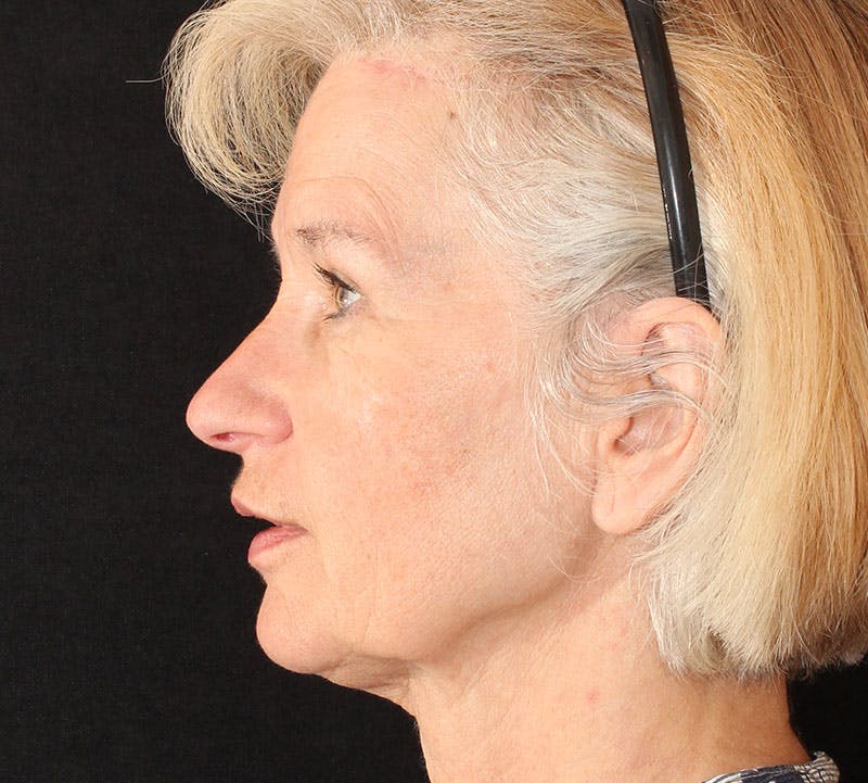 Browlift/Upper Blepharoplasty Before & After Gallery - Patient 328213 - Image 8