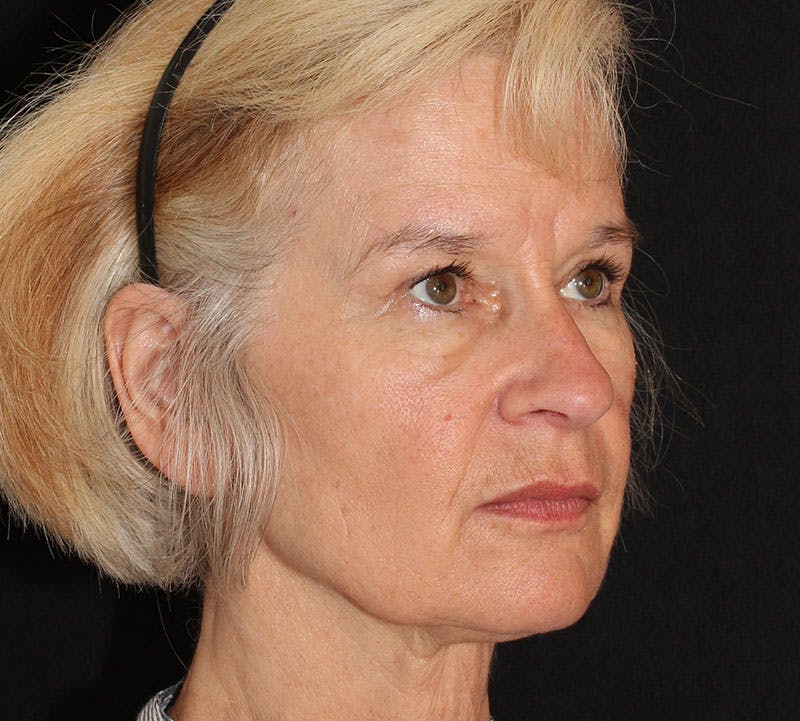Browlift/Upper Blepharoplasty Before & After Gallery - Patient 328213 - Image 4