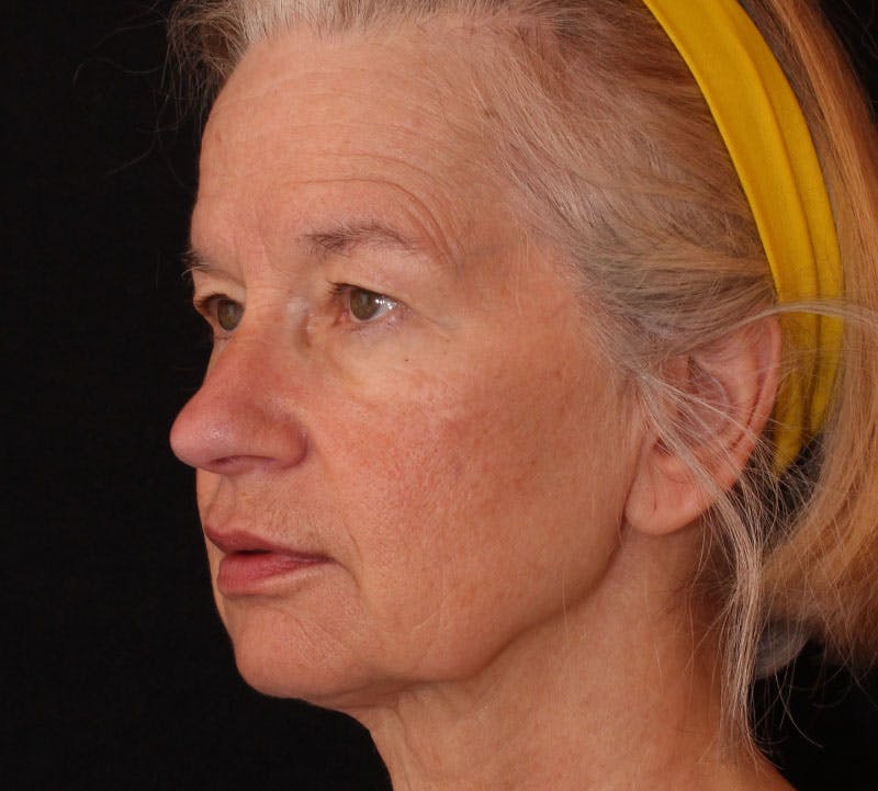 Browlift/Upper Blepharoplasty Before & After Gallery - Patient 328213 - Image 9