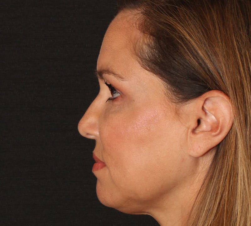 Browlift/Upper Blepharoplasty Before & After Gallery - Patient 351189 - Image 8