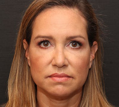 Browlift/Upper Blepharoplasty Before & After Gallery - Patient 351189 - Image 2