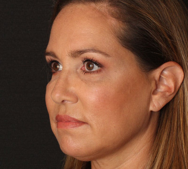 Browlift/Upper Blepharoplasty Before & After Gallery - Patient 351189 - Image 10
