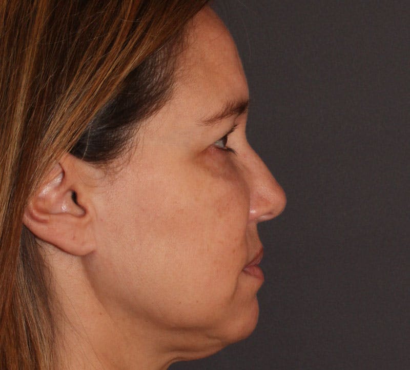Browlift/Upper Blepharoplasty Before & After Gallery - Patient 351189 - Image 5