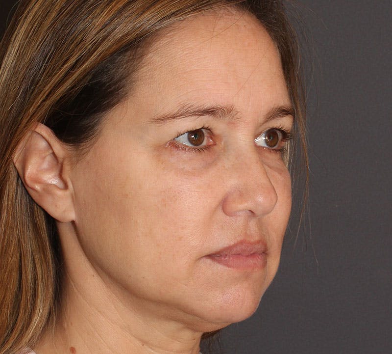 Browlift/Upper Blepharoplasty Before & After Gallery - Patient 351189 - Image 3