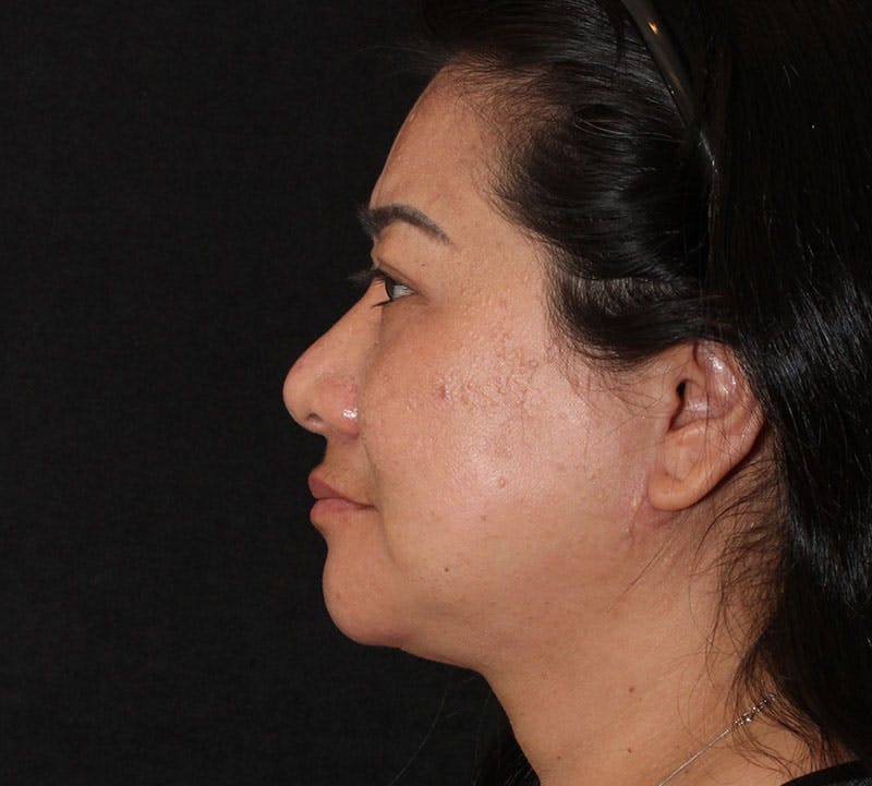 Browlift/Upper Blepharoplasty Before & After Gallery - Patient 242822 - Image 8