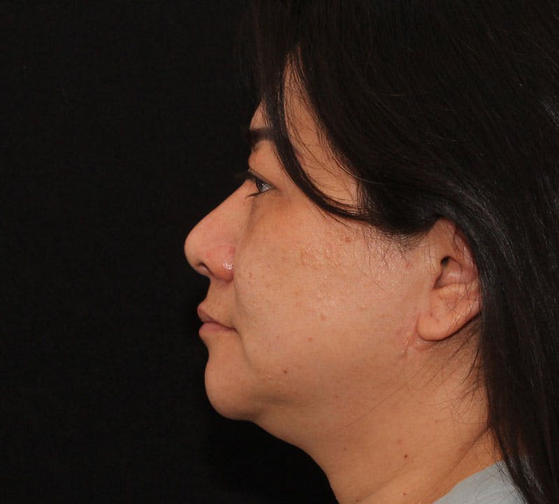 Browlift/Upper Blepharoplasty Before & After Gallery - Patient 242822 - Image 7