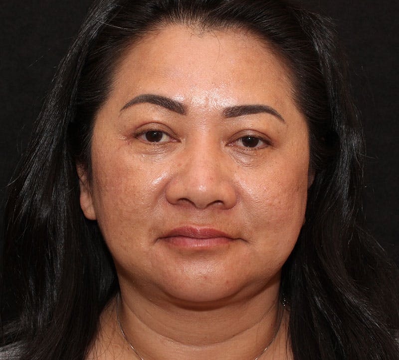 Browlift/Upper Blepharoplasty Before & After Gallery - Patient 242822 - Image 2