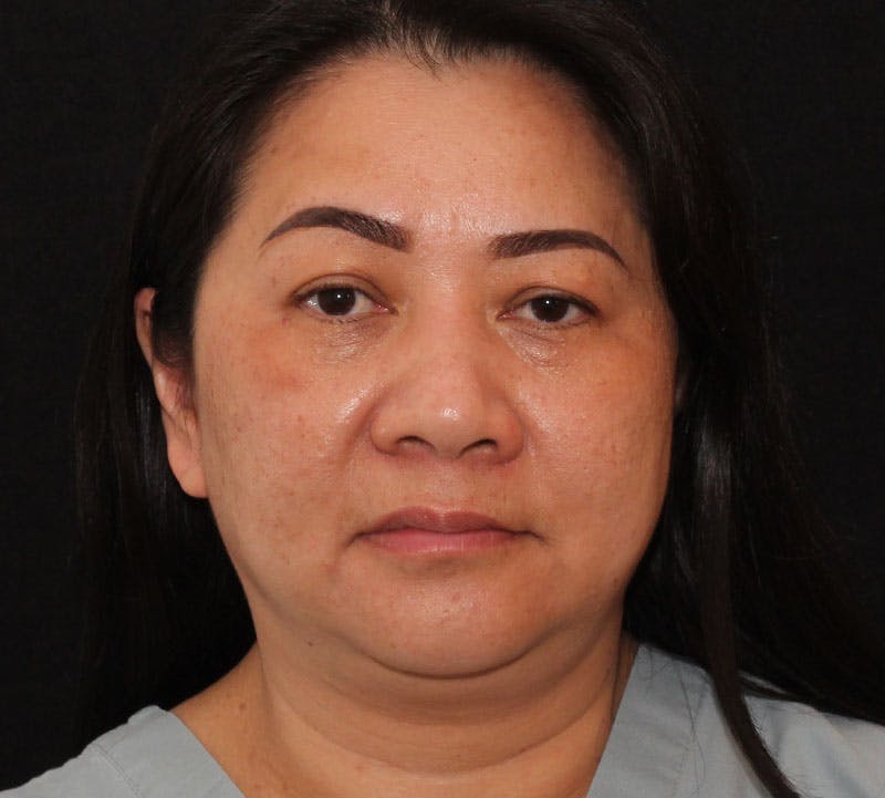 Browlift/Upper Blepharoplasty Before & After Gallery - Patient 242822 - Image 1