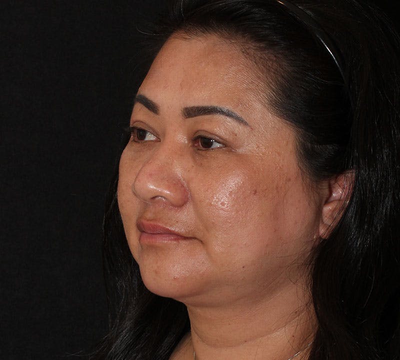 Browlift/Upper Blepharoplasty Before & After Gallery - Patient 242822 - Image 10