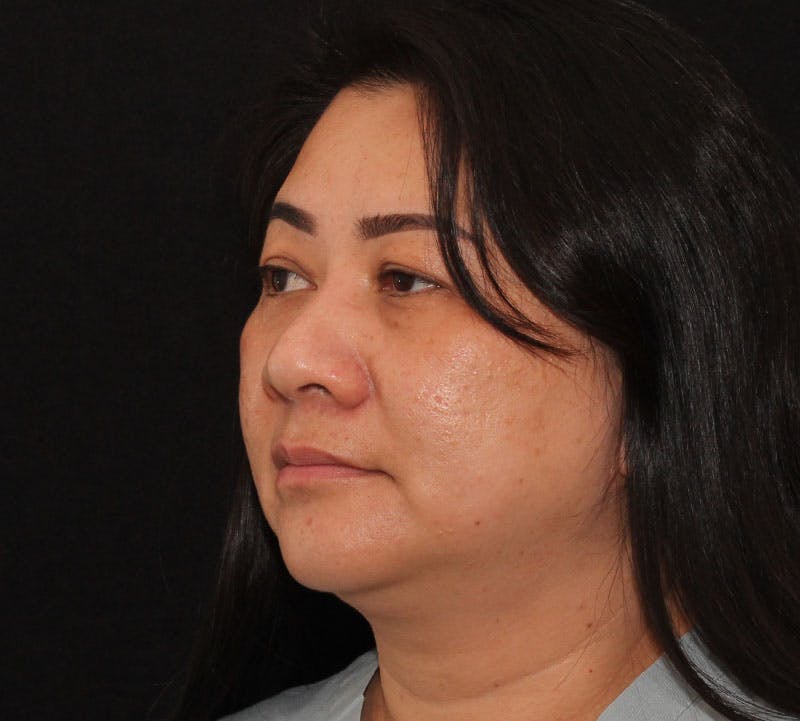 Browlift/Upper Blepharoplasty Before & After Gallery - Patient 242822 - Image 9
